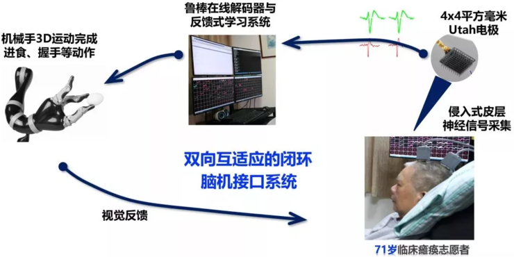 喜大普奔,国内首例植入式脑机接口临床研究取得突破性进展